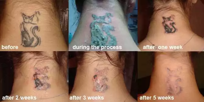 Cum Să Vă Pregătiți Înainte De Procedura De Îndepărtare A Tatuajelor