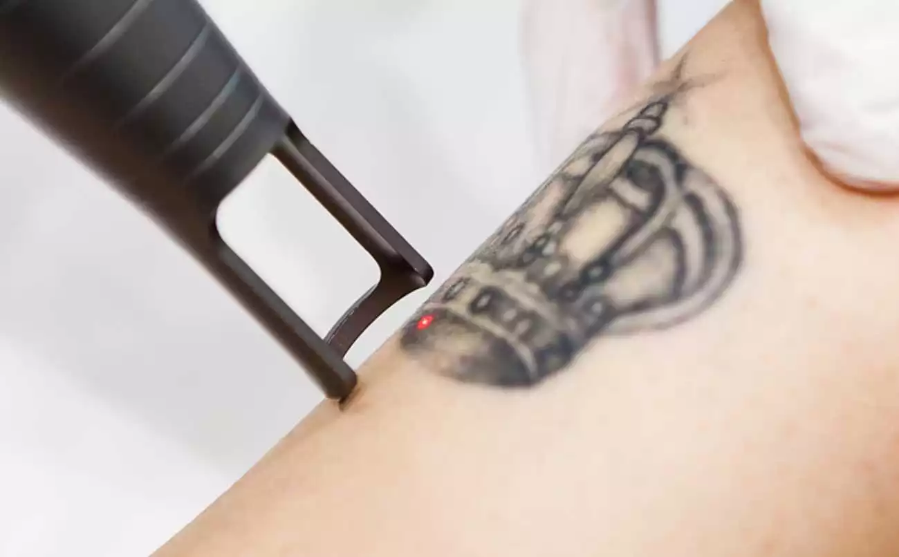 Removio în Cluj – Cum poți scăpa de tatuajele nedorite?